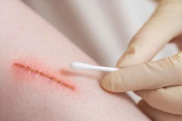 How to remove skin scars