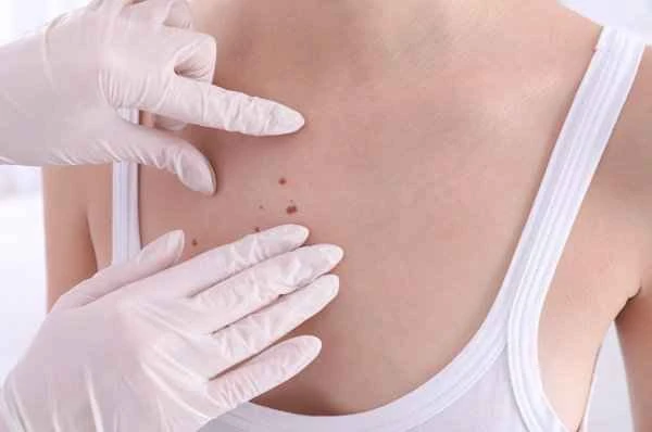 What causes a mole to break open and turn into a scar?