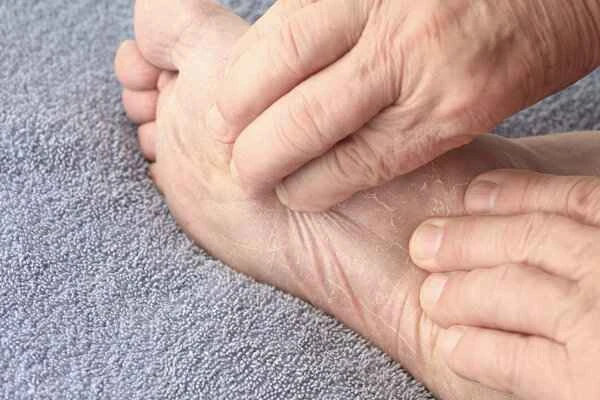 What causes severe peeling of the soles of the feet?