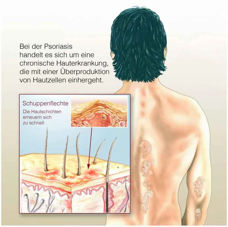 Can guttate psoriasis be cured?