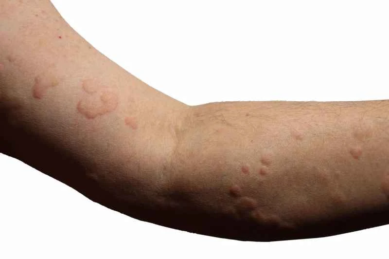 Symptoms and causes of acute urticaria