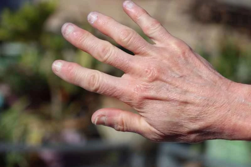 What are the symptoms of psoriatic arthritis?