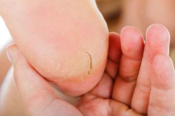 What causes severe peeling of the soles of the feet?