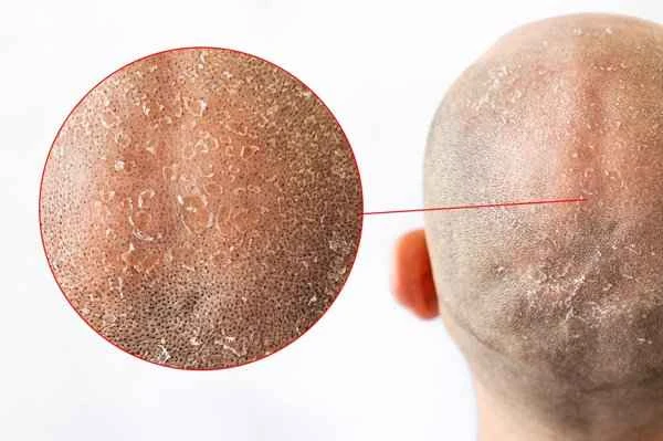 How to treat hair loss caused by clogged hair follicles?