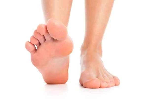 What causes severe peeling of the soles of the feet?