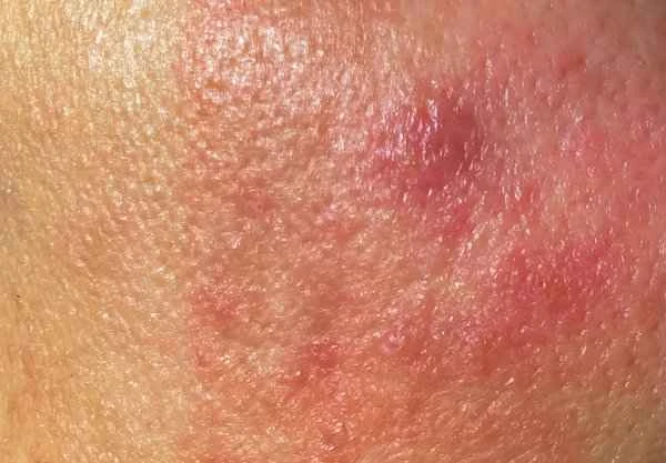 How to distinguish between swelling and red scars?