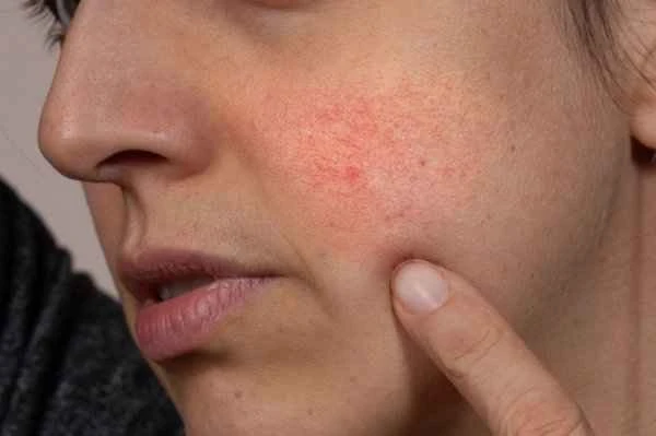 Can oligopeptides be used for seborrheic dermatitis?