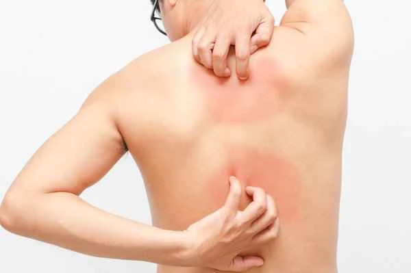 What causes back itching?