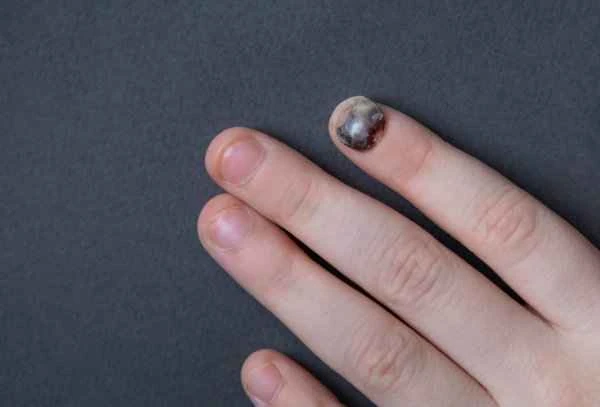What causes fingernails to turn slightly black?