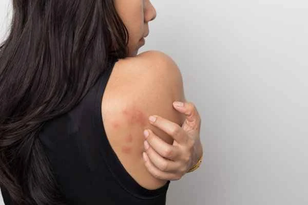 How to treat the rash that appears after the fever subsides?