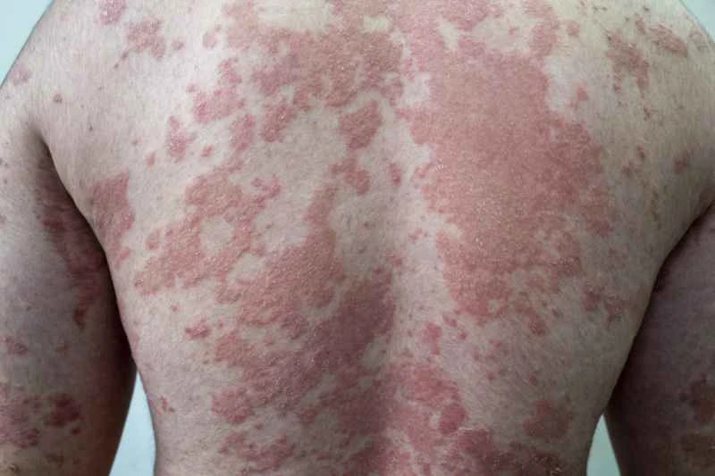 Can artificial urticaria be cured?