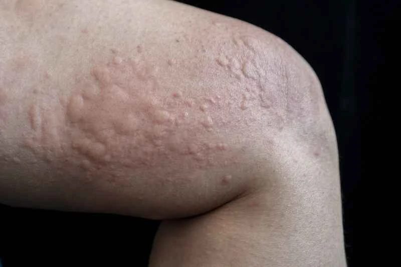 Is urticaria contagious and how is it transmitted?