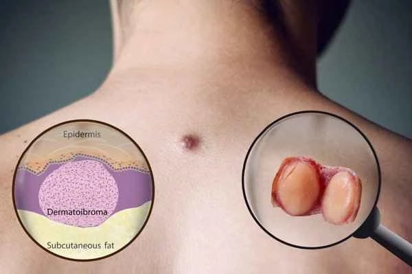 A large lump on the inside of the elbow