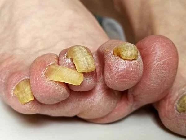 Severe erosion and infection of the big toe with athlete's foot