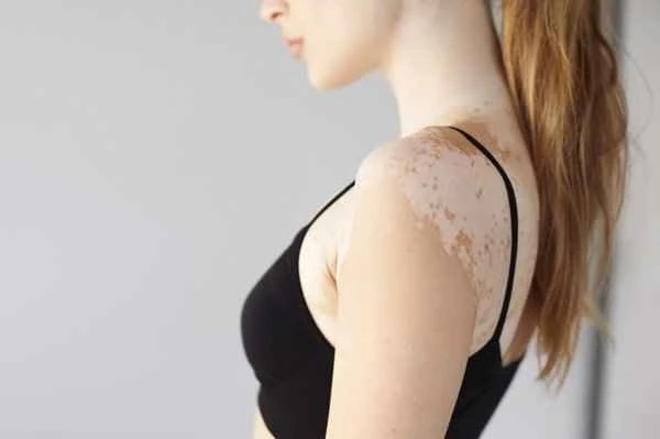 The white scars from the pterygium will disappear.