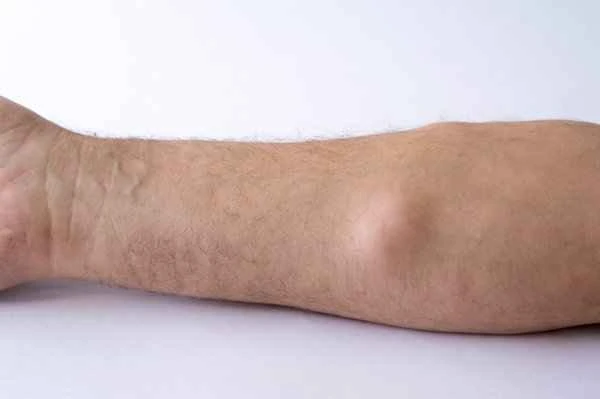 Be wary of blue veins appearing on both sides of the cheeks