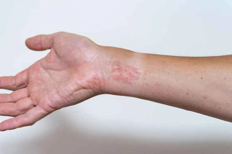 What causes eczema on the palms?