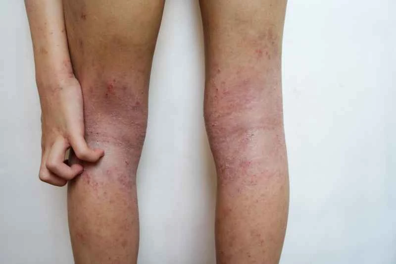 Is dry eczema contagious?