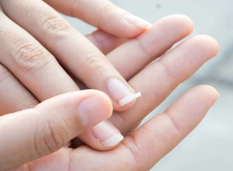 What ointment is used for nail psoriasis?