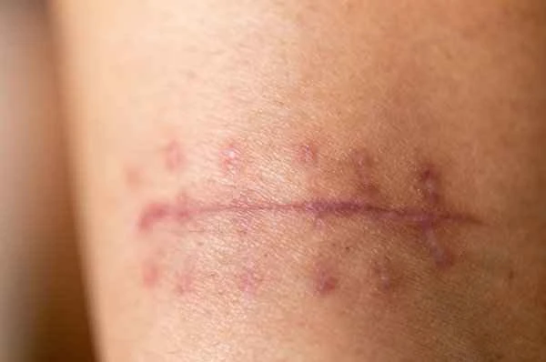 How long does it usually take for scar softening injections to show results?