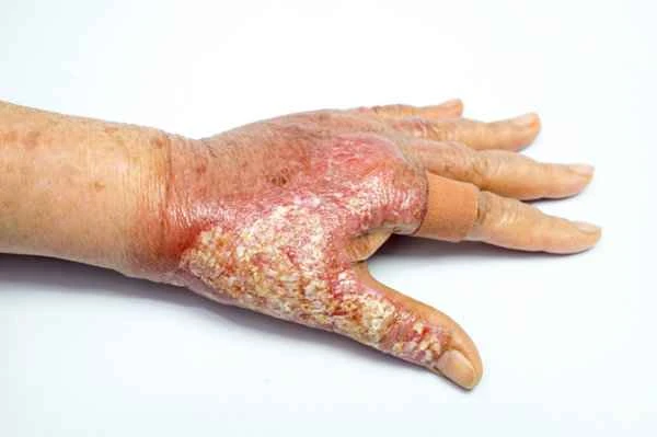 How to treat hand scar contracture?