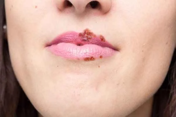 What medicine is best for treating itchy cheilitis?