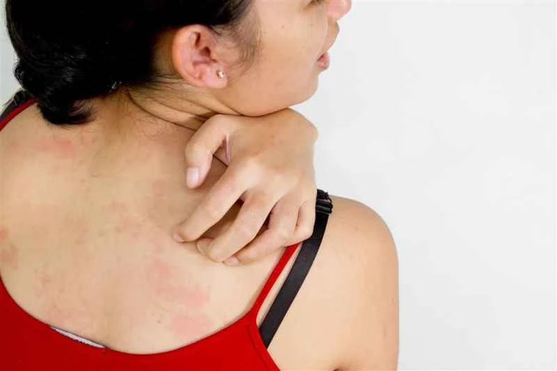 What medicine can I buy for urticaria that works quickly?