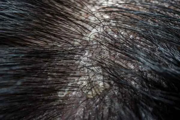 How is dandruff formed?