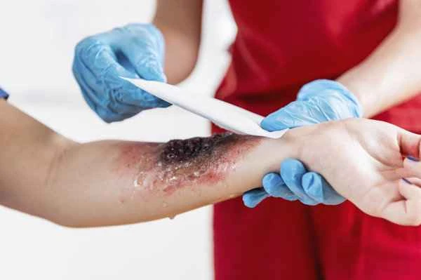 How to treat herpes scars