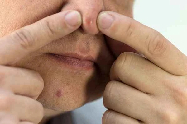 How to remove acne scars on the forehead