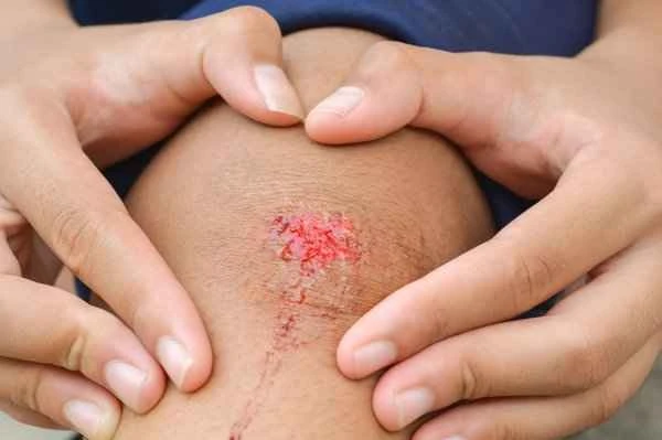 How to remove keloid scars on the knee