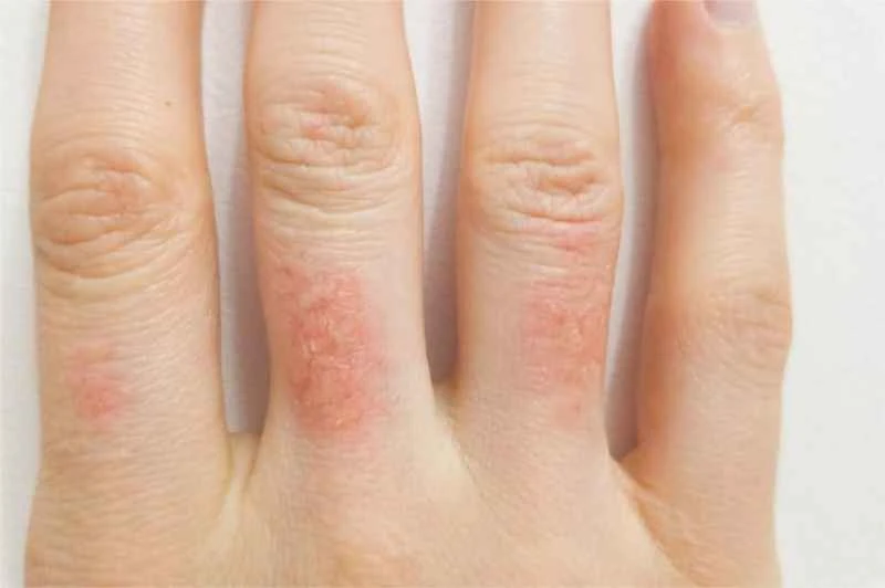 Will dry eczema spread?