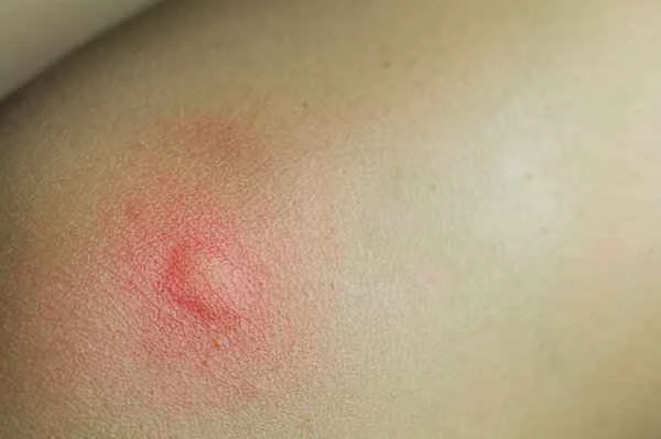 What to do about green scars on the waist?