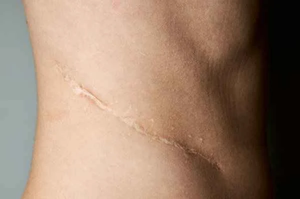 How to make scar tissue heal faster?