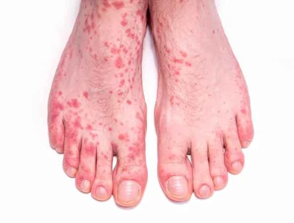 Why would someone suddenly develop dermatitis urticaria?