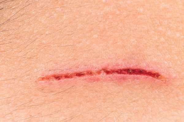 How to remove scars from injuries