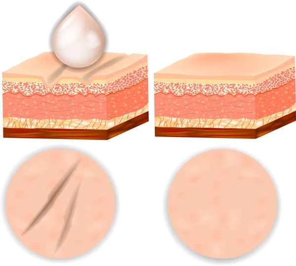 How to remove pearl scars