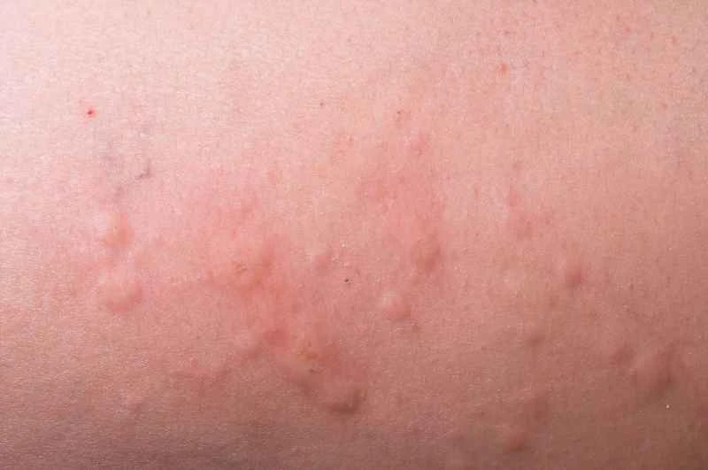 Is allergic urticaria contagious?