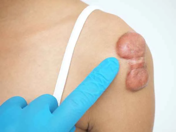 What to do about a girl with keloid scarring?