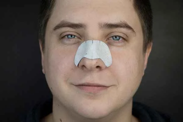 What is the best treatment for nasal root scars?