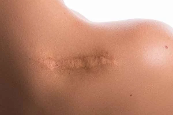 How long does it take for hypertrophic scars to stop itching and pain?