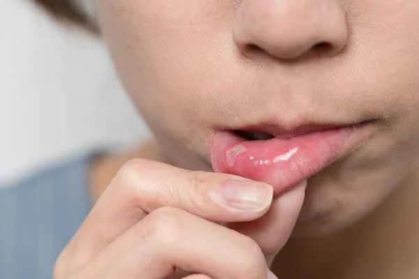 How to cure cheilitis without lip balm