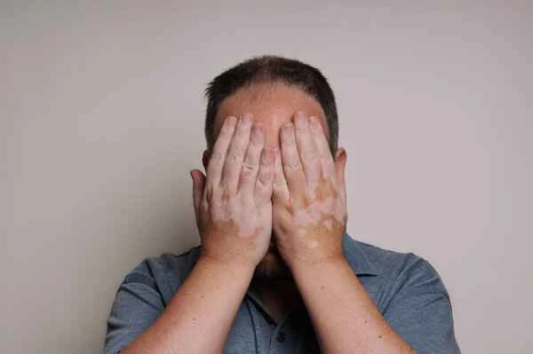 How to adjust your mindset after being diagnosed with vitiligo
