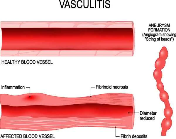 How is urticarial vasculitis diagnosed?