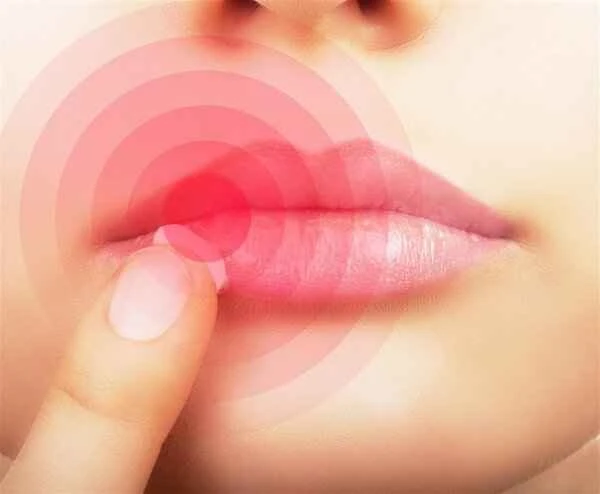 What to do about peeling and pain from cheilitis?